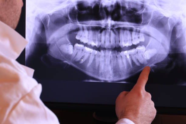 Best Emergency Wisdom Teeth Removal in Pleasanton, CA